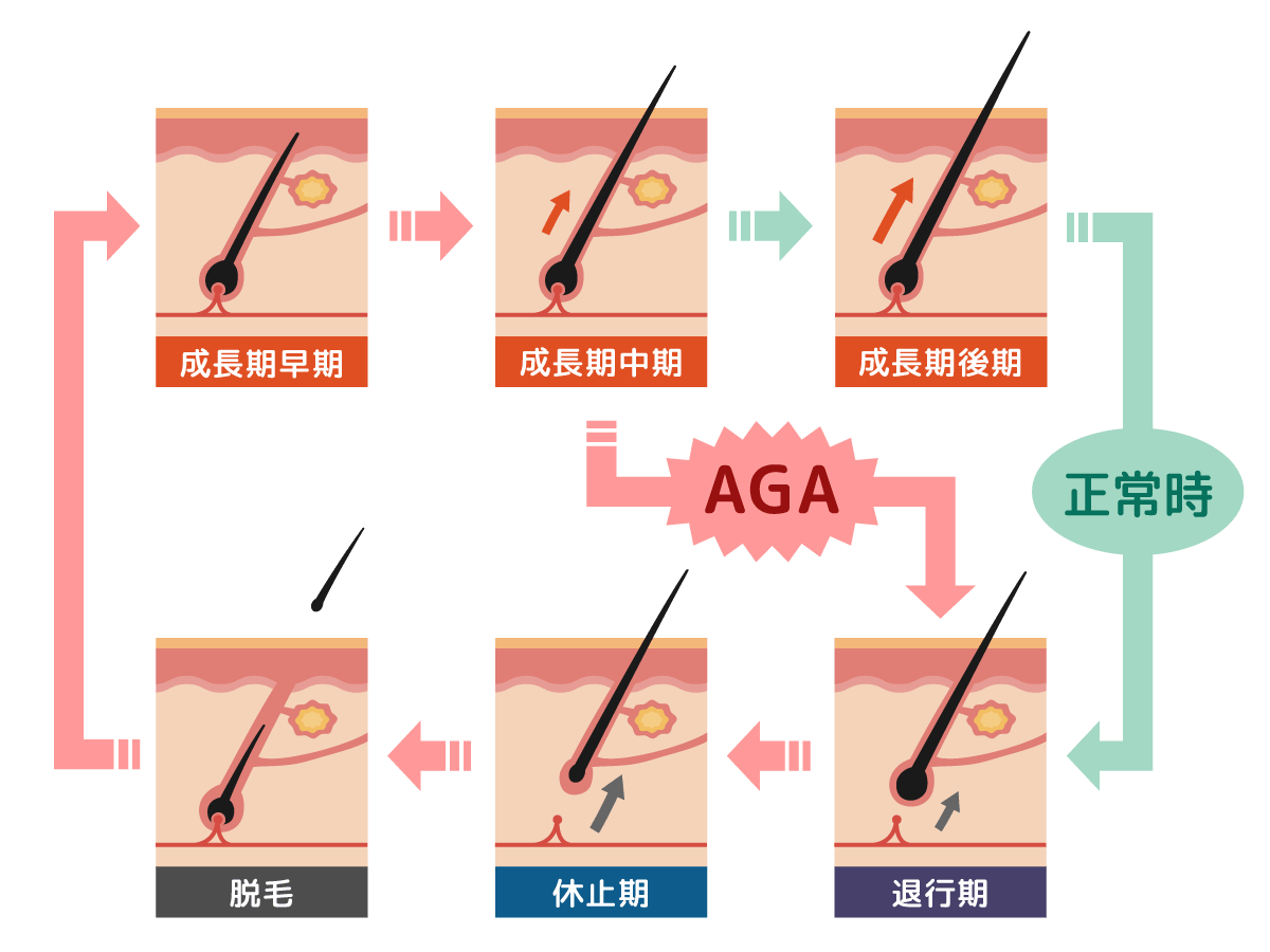 AGAが進行する仕組み