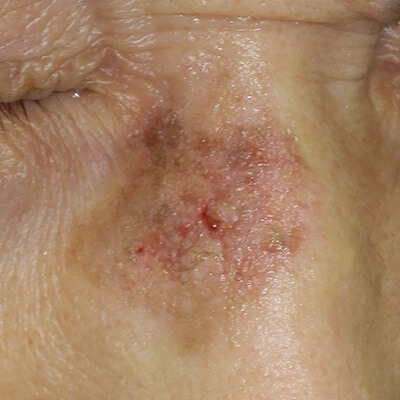 日光角化症（皮膚がんの前段階）について