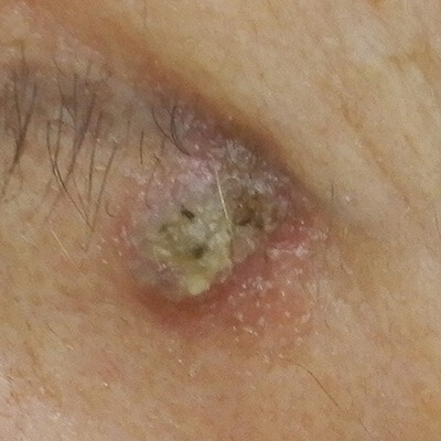 日光角化症（皮膚がんの前段階）について