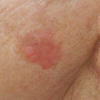 日光角化症（皮膚がんの前段階）について