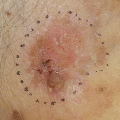 日光角化症（皮膚がんの前段階）について