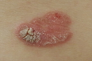 ボーエン病（早期の皮膚癌）について