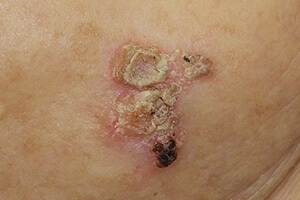 ボーエン病（早期の皮膚癌）について