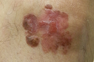 ボーエン病（早期の皮膚癌）について