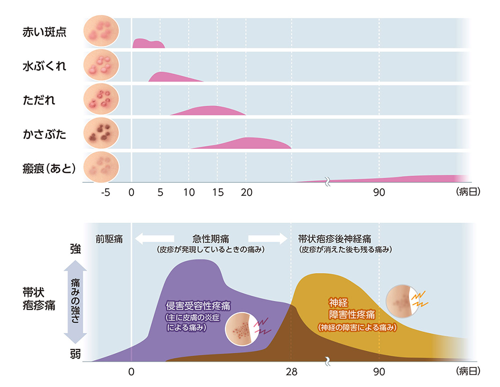 帯状疱疹の症状 グラフ