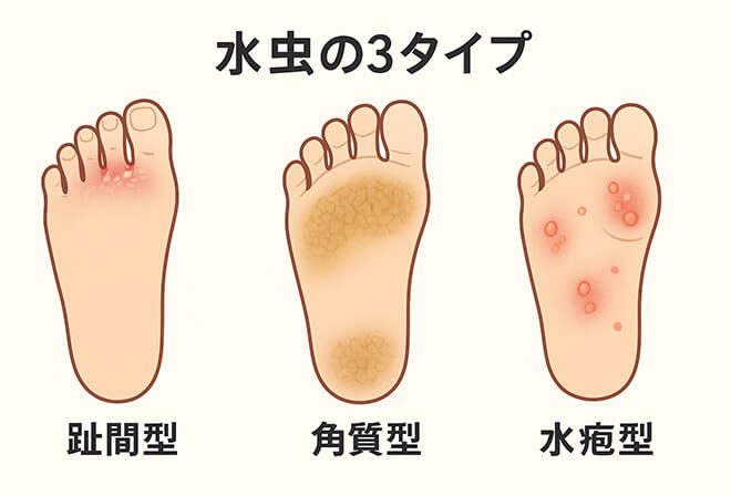 足白癬（水虫）　イメージ